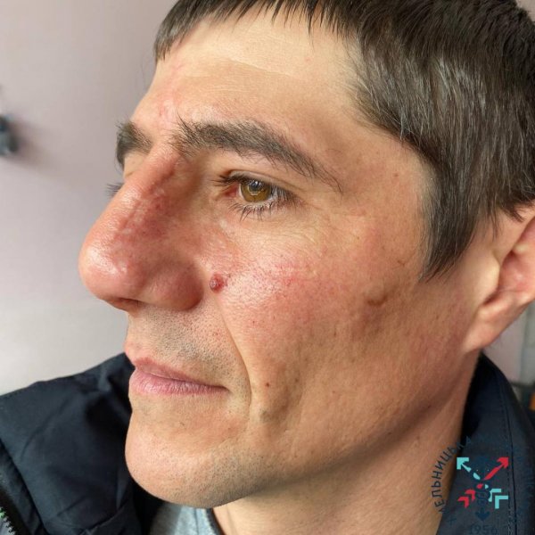 A unique operation to restore the shape of the nose was carried out in Khmelnitsky