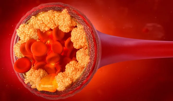 Doctors named 5 ingredients that will clean arteries without drugs