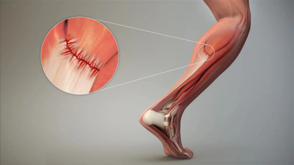 Muscle strain recovery guide: explore first aid steps, specialist roles, and rehabilitation techniques. Find out which doctor can help you get back to sport safely.